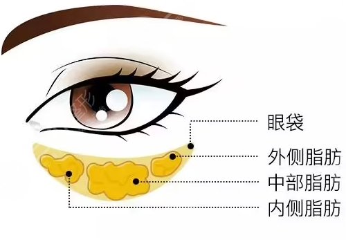 做眼袋一般需要多少钱？