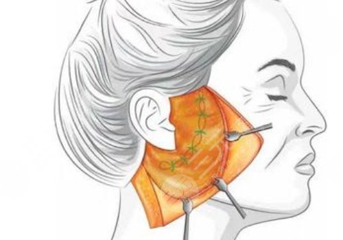 什么是筋膜悬吊面部提升术？