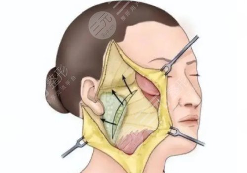 什么是筋膜悬吊面部提升术？