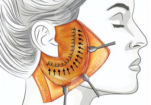 什么是筋膜悬吊面部提升术？