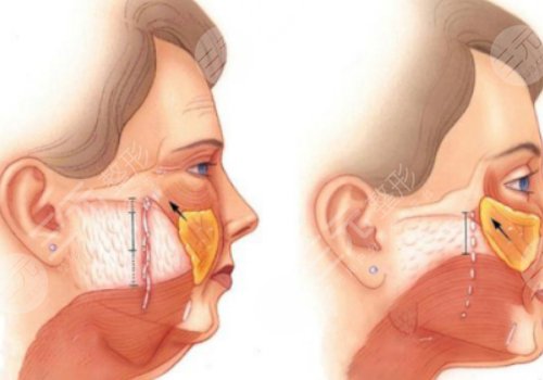 筋膜悬吊提升术能保持多久
