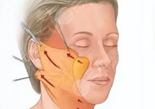 筋膜悬吊提升术能保持多久
