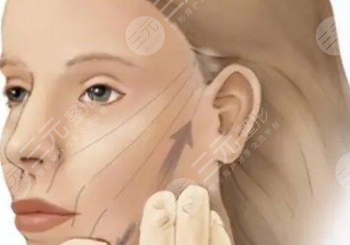 筋膜悬吊提升术能保持多久