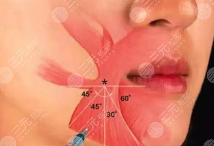 丁昆琨苹果肌复位案例