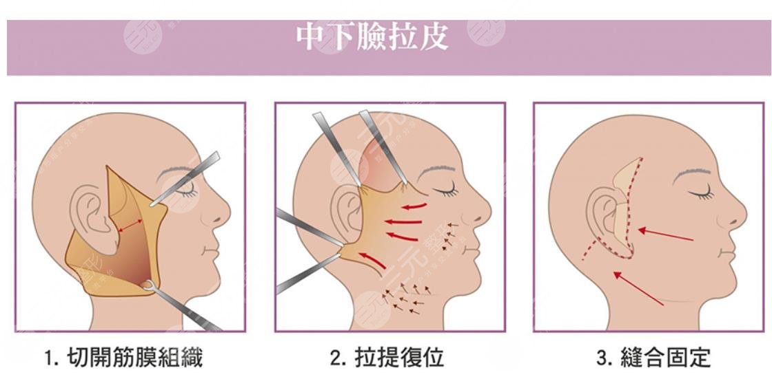 双燕尾拉皮手术