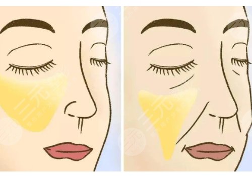 皱纹去除的好办法是什么？