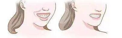 上海九院口腔科牙齿正畸案例