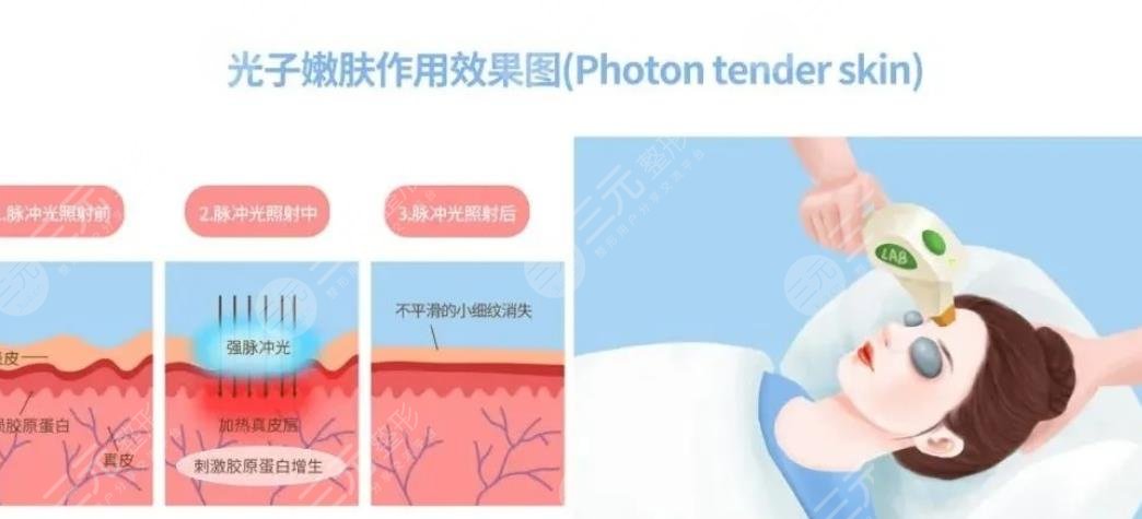 天津长征医院光子嫩肤案例