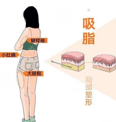 上海九院整形科吸脂手术案例