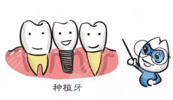 北京301医院种植牙齿案例