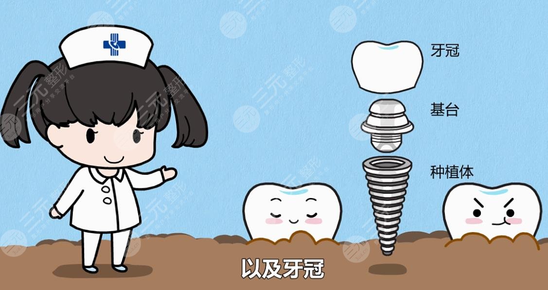 牙齿种植