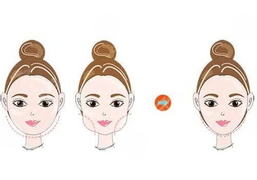 磨颧骨手术一般要多少钱？