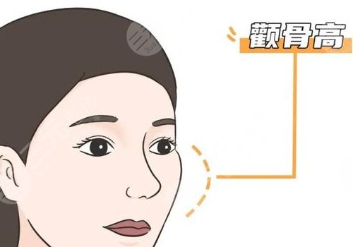 磨颧骨手术一般要多少钱？