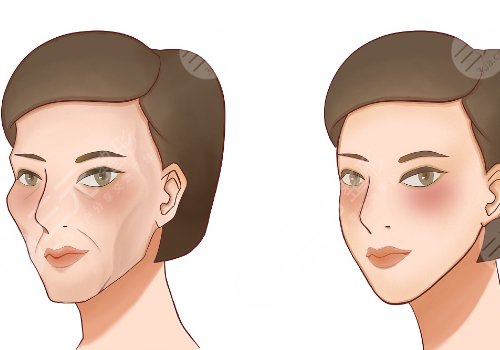 凹陷修复多少钱一个坑？