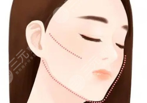 做完轮廓手术脸更大了怎么回事？