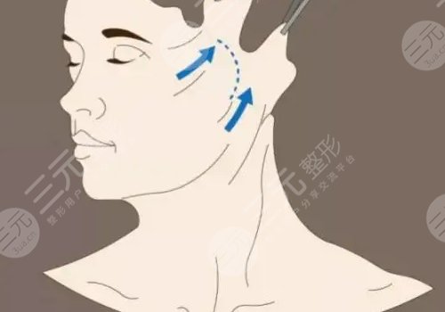 50岁做面部提升多少钱?