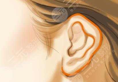 耳廓整形