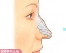 天生的驼峰鼻要怎么整形？矫正手术原理、价格费用揭晓！