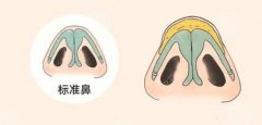 鼻尖整形的几种常见方法有哪些？3种手术原理科普！