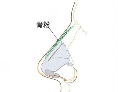 鼻整形骨粉取出