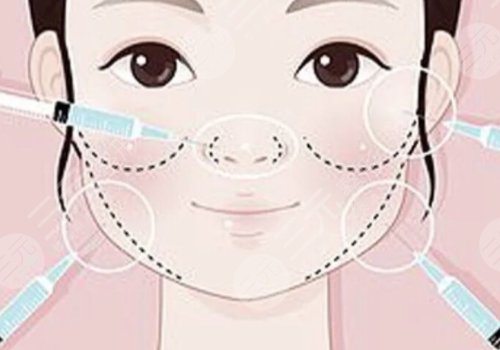 瑞蓝玻尿酸打在哪个部位?