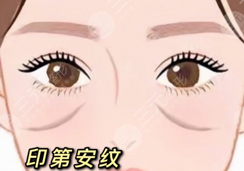 印第安纹是怎么形成的还能消除吗