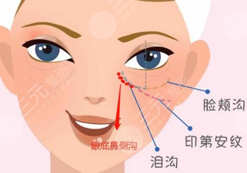 印第安纹是怎么形成的还能消除吗