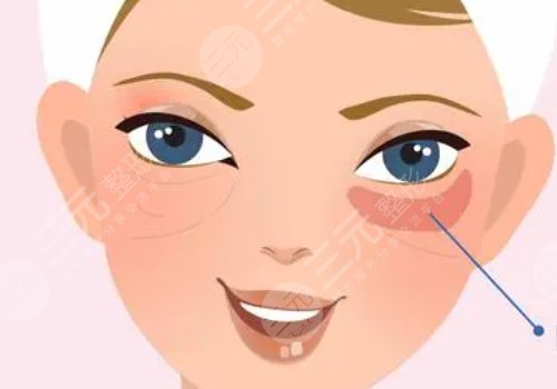 肿眼泡怎么消除？