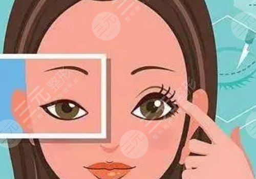 肿眼泡怎么消除？