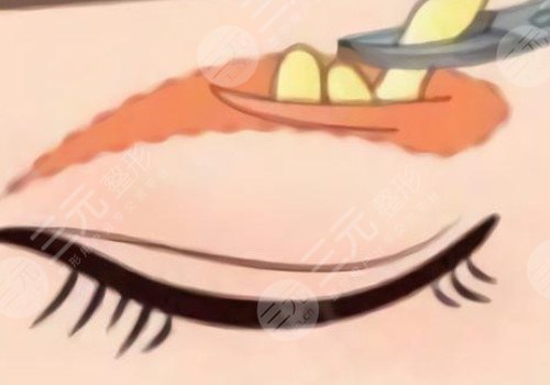 肿眼泡做双眼皮埋线好还是割好？