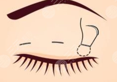 肿眼泡做双眼皮埋线好还是割好？