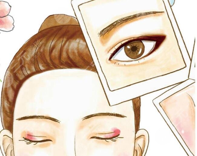 上睑矫正结合双眼皮