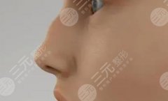 驼峰鼻要怎样整形好？手术方案分析，美鼻指南针get！