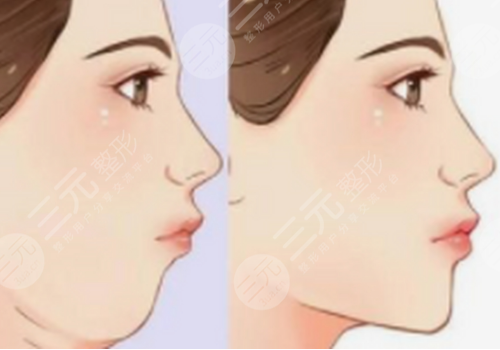 轮廓固定打什么针效果好一点