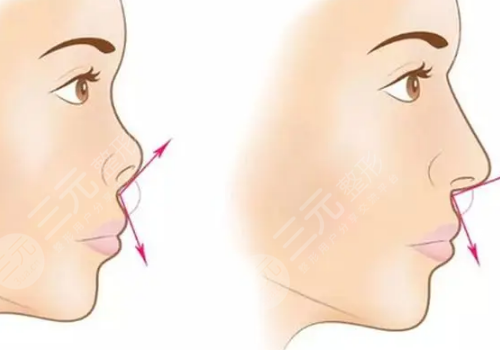 垫鼻基底前后对比