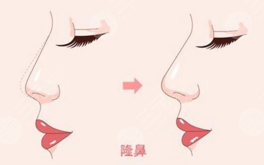 深圳北大医院隆鼻案例