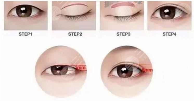 澄海南方医院割双眼皮多少钱