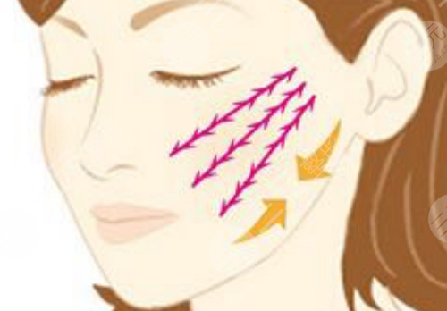 黑金dpl超光子嫩肤和m22区别