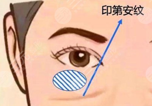 印第安纹和泪沟的区别是什么？