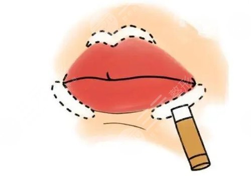 唇部填充用脂肪还是玻尿酸?