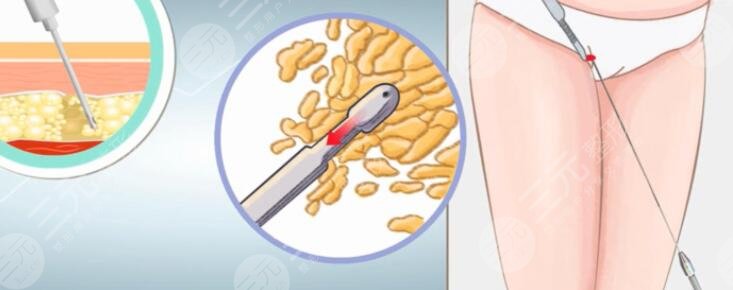 震动吸脂和水动力吸脂的原理一样吗?