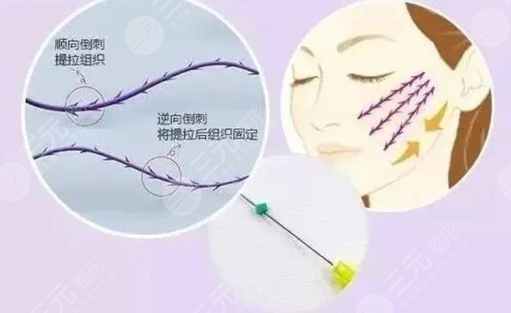 双矢量提升术和筋膜悬吊术哪个好