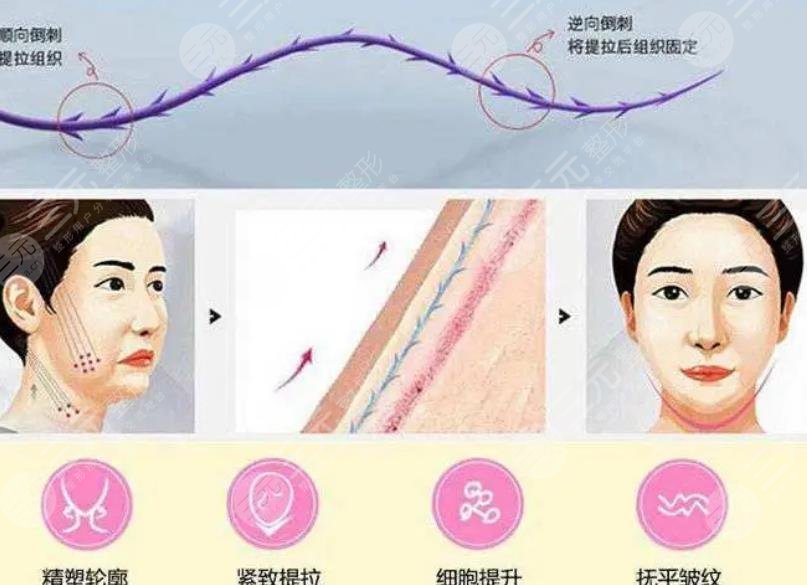 双矢量提升术和筋膜悬吊术哪个好