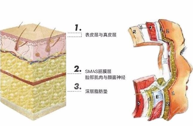 埋线提升