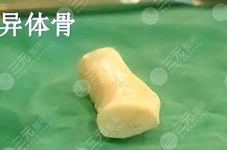 膨体异体骨鼻综合