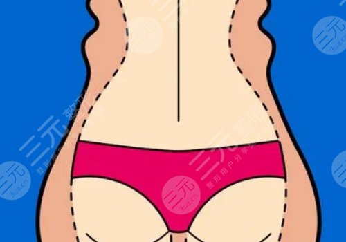 腰腹环吸大概多少钱