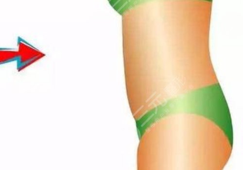 腰腹环吸大概多少钱