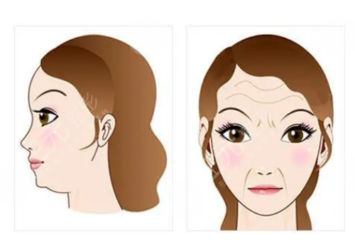 额头填充玻尿酸能保持多久