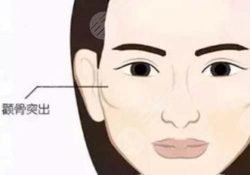 颧骨高怎么改良脸型？