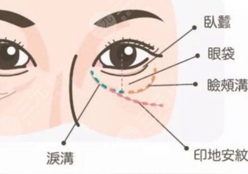 印第安纹填充胶原蛋白和玻尿酸哪个好？